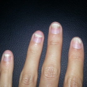 Odlupování nehtu od lůžka