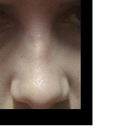 Pooperační péče tvrdé i měkké části nosu