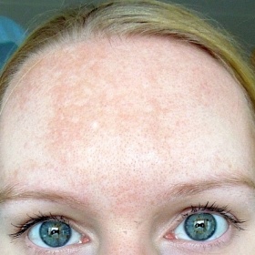 Pigmentové skvrny - lze se jich zbavit laserem?