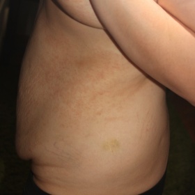 Abdomioplastika včetně liposukce