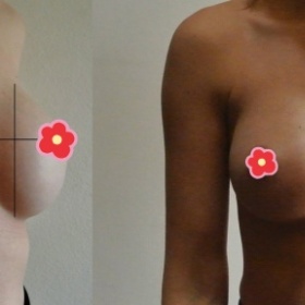 Nízko položené implantáty