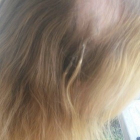 Lysina ve vlasech po vytrhání vlastních vlasů