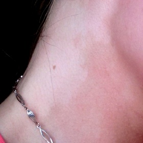 Bílá mapa na krku po opalování