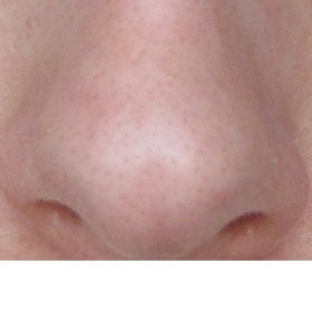 Fleky a ďolíky po akné - nic nepomáhá