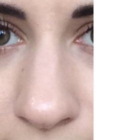 Život v zahraničí, rhinoplastika v ČR - časová náročnost