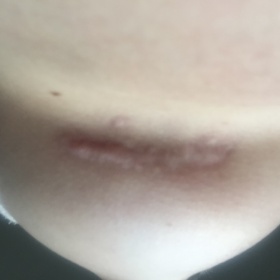 Široké jizvy po augmentaci