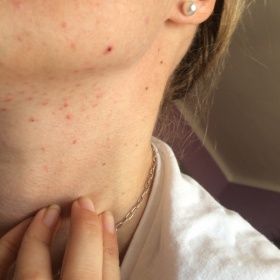 Pupence na krku a tváři -