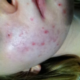 Strašné akné, nic nepomáhá, zdravý životní styl mám