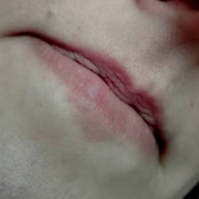 Atopický ekzém na rtu