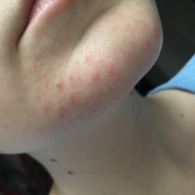 Akné - poznáte podle fotek?