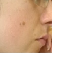 Hnědé skvrnky po odstranění pihy laserem