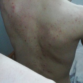 Acne vulgaris nebo něco jiného?