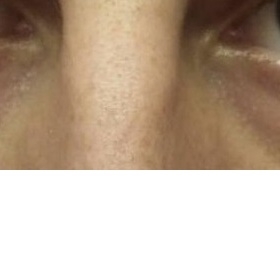 Operace dolních víček a každodenní práce u počítače, muž 26 let