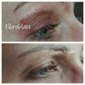 Fibroblast - neinvazivní lifting očních víček, vrásek atd.