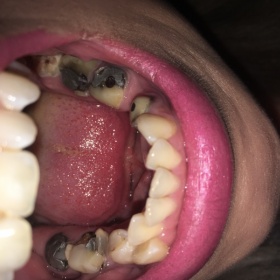 Rovnátka, nebo plná pusa korunek?