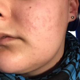 Akné z hormonální antikoncepce