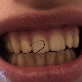 Tečka (mírná prohlbeň) na předním zubu