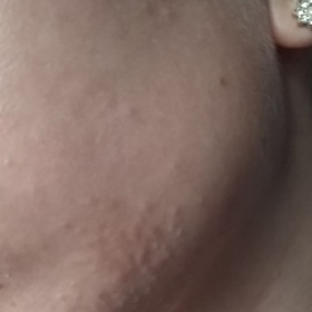 Krupička na obličeji (na tváři a bradě)