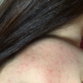 Pupínky po obličeji