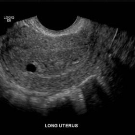 Gestační váček v děloze
