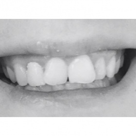 Rovnátka v dospělosti