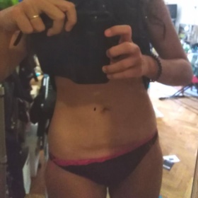 Indikace pro miniabdominolastiku