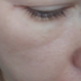 Jak odstranit hlubokou vrásku pod okem směrem do tváře?