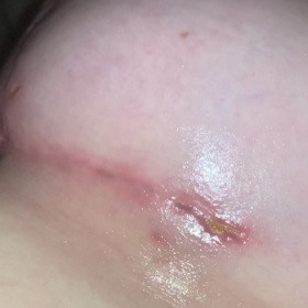 Hnis měsíc po augmentaci