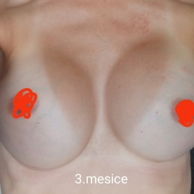 Asymetrie po augmentaci