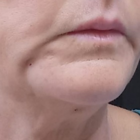 Aptos - marionety a podbradek - horší vzhled než před zákrokem