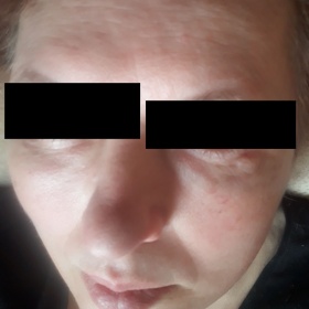 Tuková boule po lipoliftingu