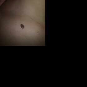 Větší znaménko - lze odstranit laserem?