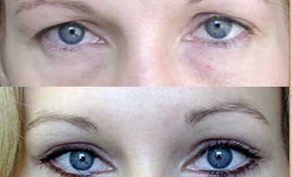 Operace horních víček 1