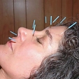 Akupunktura 5