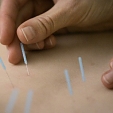 Akupunktura 6