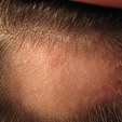 Alopecie 1
