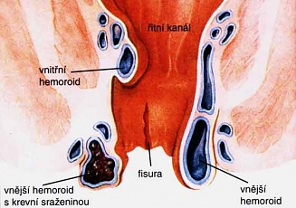 Hemoroidy (hemeroidy) 1