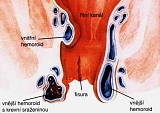 Hemoroidy (hemeroidy) 3