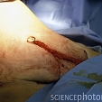 Plastická operace břicha (abdominoplastika) 1