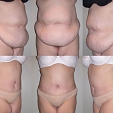 Plastická operace břicha (abdominoplastika) 2