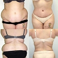 Plastická operace břicha (abdominoplastika) 3