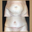 Plastická operace břicha (abdominoplastika) 4