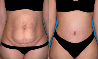 Plastická operace břicha (abdominoplastika) 1
