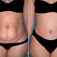 Plastická operace břicha (abdominoplastika) 5