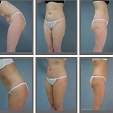 Plastická operace břicha (abdominoplastika) 6