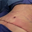 Plastická operace břicha (abdominoplastika) 8