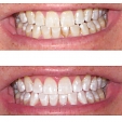 Bělení zubů 3
