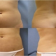 Laserová liposukce – CoolLipo 2