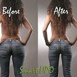 Liposukce – SmartLipo 3