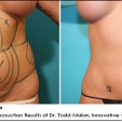 Water+jet liposukce (WAL) 3